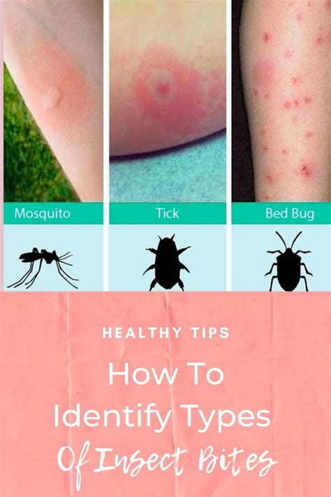 jolie bites|Identifying Insect Bites: Pictures Of 11 Common Bug Bites .